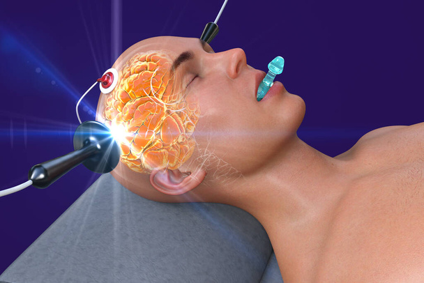 Elektroconvulsieve therapie, ECT, een behandeling voor ernstige geestesziekten waarbij elektrische stromen worden gebruikt om de hersenen te stimuleren, 3D-illustratie - Foto, afbeelding