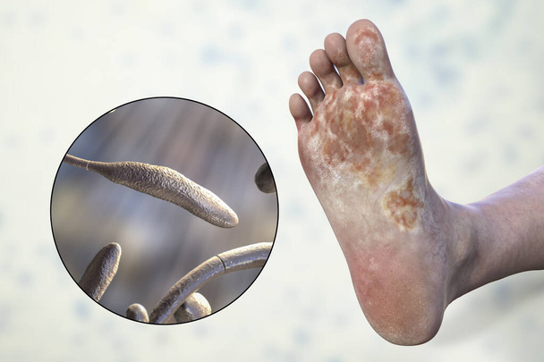 Noha s mykózou, a detailní pohled na houby Trichophyton rubrum, které způsobují nohu sportovce, 3D ilustrace - Fotografie, Obrázek