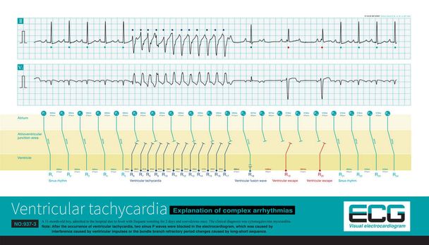 An 11 month old male infant was clinically diagnosed with viral myocarditis and experienced transient atrioventricular block after ventricular tachycardia, resulting in complex arrhythmias. - Photo, Image