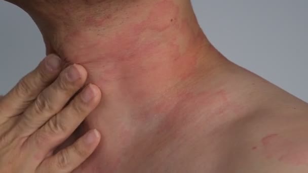 Zbliżenie obrazu tekstury skóry cierpiącej na ciężką pokrzywkę lub pokrzywkę lub kaligata na szyi. Objawy alergii. - Materiał filmowy, wideo