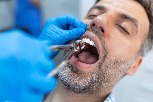 Chirurgien enlevant la dent. Dentiste utilisant une pince chirurgicale pour enlever une dent en clinique - Photo, image