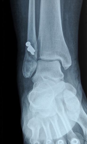 röntgenkuva ihmisen pohjeluun murtumasta
 - Valokuva, kuva