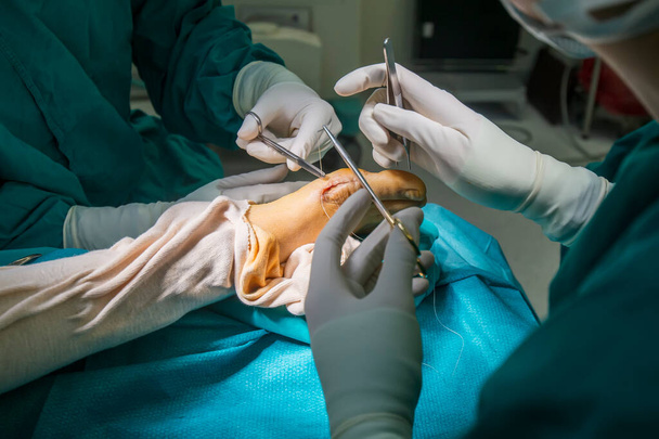 Hand of doctor or surgeon did foot surgery inside an operating room in the hospital.People in green gown used medical tools to suture the surgical wound.Foot and toe surgery of bunion.Light effect. - Photo, image