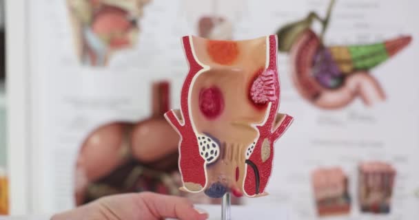 Anatomy of anus and treatment of diseases of rectum with hemorrhoids. Proctologist and rectal pathology on anatomical model - Video