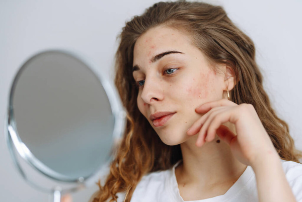 Young woman  with problem skin looking into mirror. Dermatology. Allergic reaction from cosmetic, red spot or rash on face.  Beauty care.  - Foto, Imagem