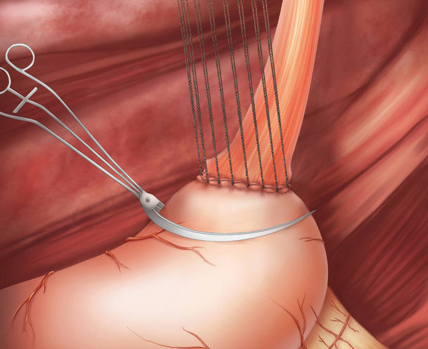 Cirugía de anastomosis gastroesofágica.Esta ilustración médica muestra la técnica de anastomosis del estómago y el esófago remanentes.. - Foto, imagen