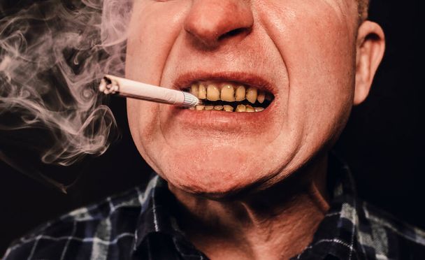 Τσιγάρο στο στόμα του. Πλακάκια δοντιών και παραθυρόδοντες. Το κάπνισμα προκαλεί προβλήματα τερηδόνας και κακό χαμόγελο. Οδοντιατρική θεραπεία. Βλάβη συνήθεια. - Φωτογραφία, εικόνα