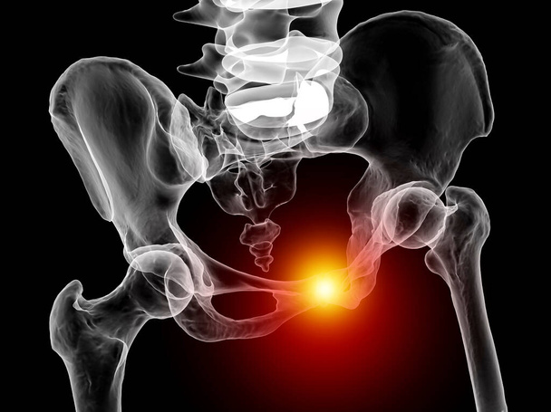 Disfunción de la sínfisis pubis, ilustración 3D que muestra huesos pélvicos y resaltado en sínfisis de pubis rojos - Foto, Imagen