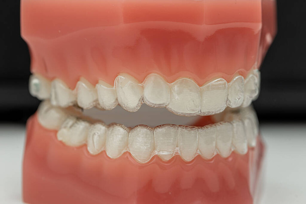 Näkymätön ja irrotettava kohdistimet hampaiden linjaus - Valokuva, kuva