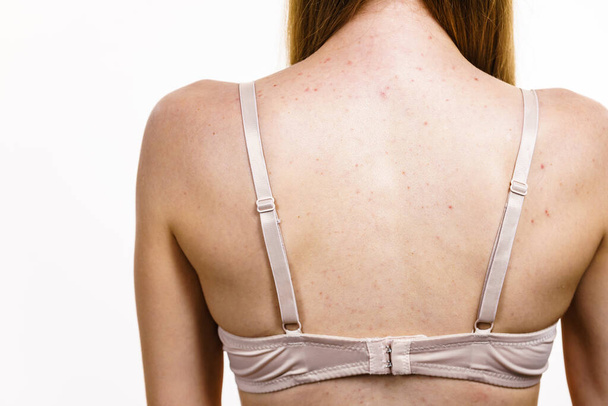 Health problem, skin diseases. Young woman showing her back with acne, red spots. Teen girl with many pimples. - Foto, imagen