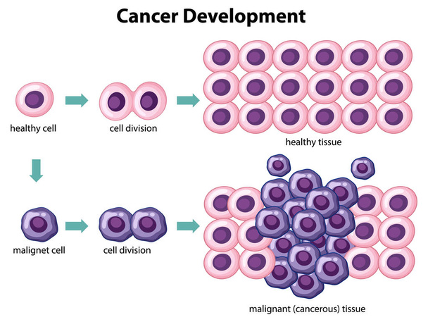 Cancer Development vector with information illustration - Vector, Image