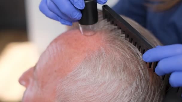 Detailní záběr trichologa, jak zkoumá staršího muže. Problém plešatosti a vypadávání vlasů. - Záběry, video