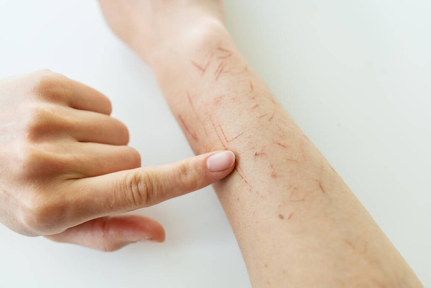 O médico examina a mão, a pessoa é arranhada por toda parte, pele seca na mão, feridas na mão, cicatrizes, psoríase vulgar, eczema ou outras doenças da pele. Doença genética autoimune diversa - Foto, Imagem