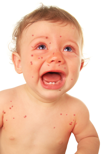 Bebé llorón con sarampión
 - Foto, Imagen