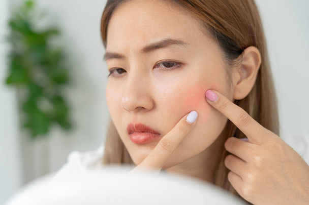 Junge asiatische Frauen sind besorgt über Gesichter Dermatologie und allergisch gegen Steroide in Kosmetika. Empfindliche Haut, rotes Gesicht von Sonnenbrand, Akne, allergisch gegen Chemikalien, Hautausschlag im Gesicht. Hautprobleme und Schönheit - Foto, Bild