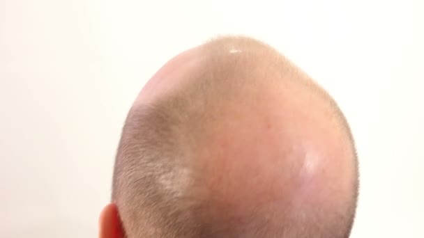 Bald Spot on Male Head - Footage, Video