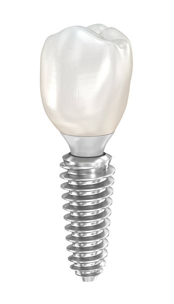 Dental implant and ceramic crown. Medically accurate tooth 3D illustration. - Фото, изображение