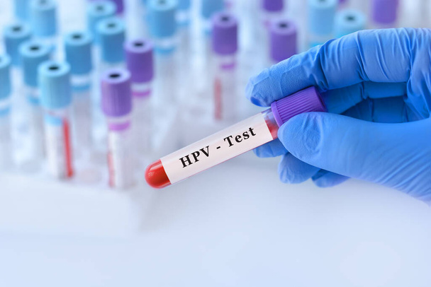 Analizli tıbbi test tüplerinin arka planında HPV testi olan bir test tüpü tutan doktor.. - Fotoğraf, Görsel