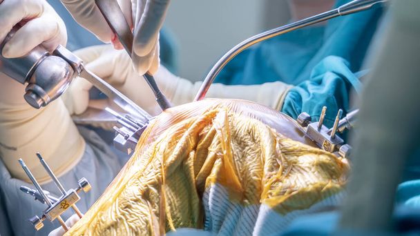 Ομάδα του γιατρού ή χειρουργού σε μπλε φόρεμα μέσα στο χειρουργείο στο νοσοκομείο.Χειρουργός έκανε ολική αρθροπλαστική γόνατος χειρουργική τεχνολογία.Οστεοτομή με ιατρικό πριόνι σε ορθοπεδική μονάδα.Ελαφρύ φόντο. - Φωτογραφία, εικόνα