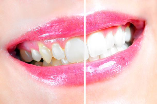 dentystyczne wybielanie - Zdjęcie, obraz