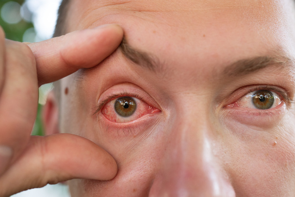 Closeup irritated infected red bloodshot eyes, conjunctivitis. Inflammation of the eyes in men - Photo, Image