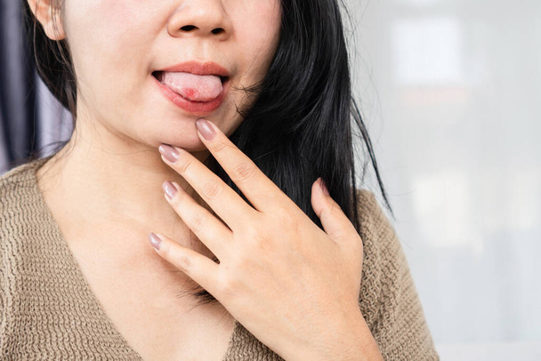 Aasialainen nainen on kipeä suussa, kieli, aftainen haavauma - Valokuva, kuva