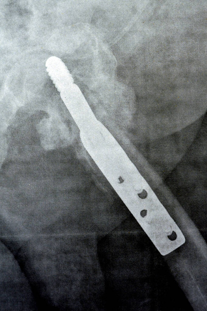 A combcsonttörés bal csípőtáji nyaki transz-nyaki nyaki törése, amelyet a DHS Dynamic Hip Screw rögzít, egy idős beteg PXR síkröntgenje, egy combfej-kímélő ortopédiai eszköz, a combnyaktörések kezelésére szolgál. - Fotó, kép