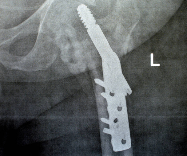 A combcsonttörés bal csípőtáji nyaki transz-nyaki nyaki törése, amelyet a DHS Dynamic Hip Screw rögzít, egy idős beteg PXR síkröntgenje, egy combfej-kímélő ortopédiai eszköz, a combnyaktörések kezelésére szolgál. - Fotó, kép