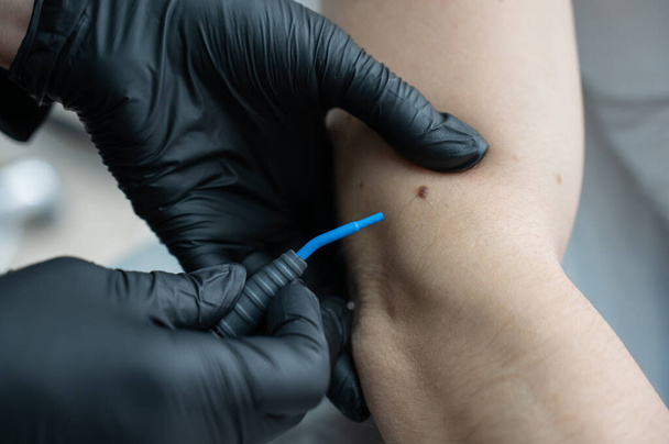Dermatologist removes a mole on a patients arm using an electrocoagulator - Foto, afbeelding