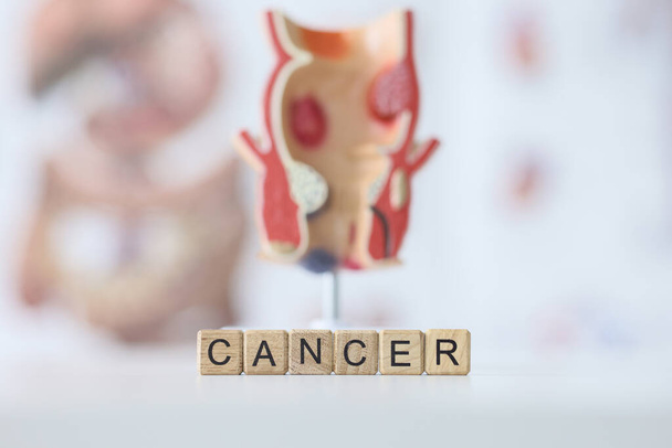 Word Καρκίνος κατασκευασμένο από ξύλινους κύβους κατά ρεαλιστικό μοντέλο του ανθρώπινου ορθού με συμπτώματα της νόσου στο λευκό τραπέζι στην κλινική. Εντερική ογκολογία - Φωτογραφία, εικόνα