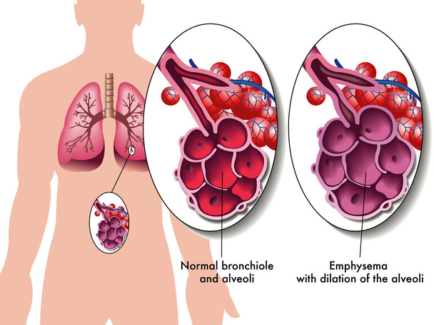 Emphysème pulmonaire
 - Vecteur, image