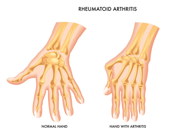 reumatoïde artritis - Vector, afbeelding
