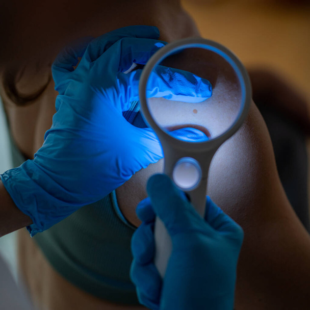 Dermatologist examining skin mole for cancer prevention and early intervention. Examining moles for potential malignancy  - Photo, image