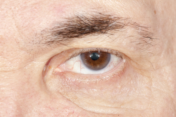 老人性白内障の眼の検査 - 写真・画像