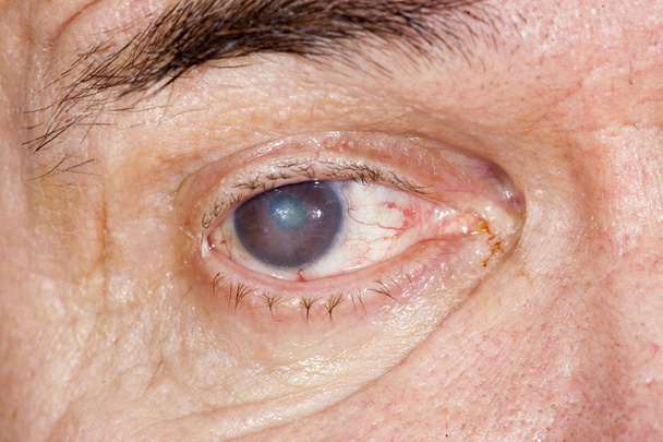 Exame ocular de catarata senil
 - Foto, Imagem
