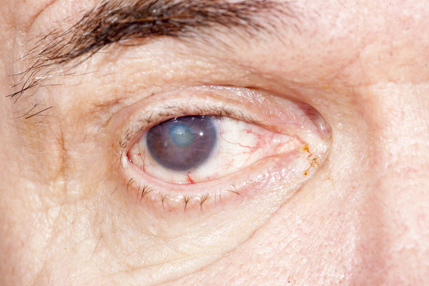 Senile cataract eye examination - Photo, Image