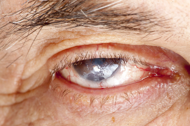 Senile cataract oog onderzoek - Foto, afbeelding