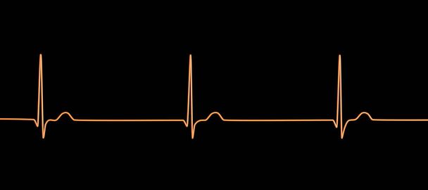Электрокардиограмма ЭКГ, отображающая узловой ритм, который возникает, когда электрические сигналы в сердце исходят от атриовентрикулярного узла вместо синоатриального узла, 3D иллюстрация - Фото, изображение