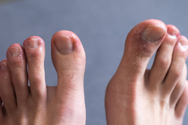 Los dedos de los pies de un hombre muestran lo que parece una erupción con la piel manchada de rojo. Un efecto secundario común de Covid-19 a menudo conocido como Covid toe - Foto, Imagen