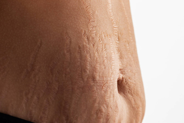 Γυναικεία κοιλιά με closeup ραγάδες - Φωτογραφία, εικόνα