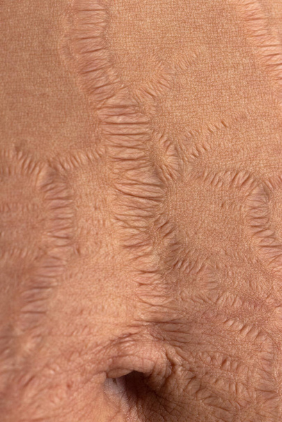 Close-up menselijke huid natuurlijke striae textuur achtergrond. Strek merk vrouw buik. - Foto, afbeelding