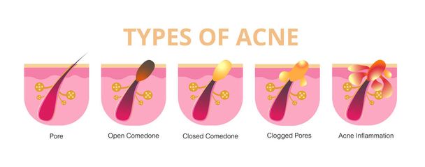 Acne, stages of development,healthy skin,vector design - Vector, Image
