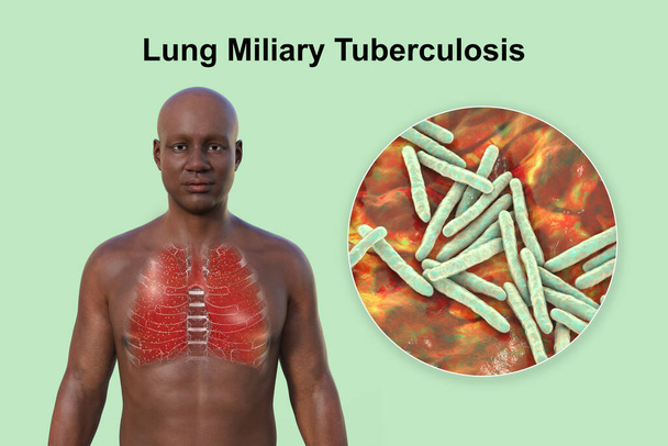Een 3D fotorealistische illustratie van de bovenste helft van een man met een transparante huid, die de longen laat zien die getroffen zijn door miliaire tuberculose en een close-up van Mycobacterium tuberculosis bacteriën - Foto, afbeelding