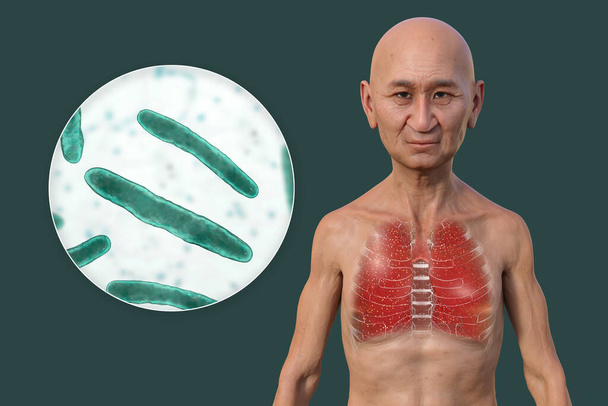 Eine fotorealistische 3D-Illustration der oberen Hälfte eines Mannes mit transparenter Haut, die die von miliärer Tuberkulose betroffenen Lungen zeigt und die Mycobacterium tuberculosis-Bakterien aus der Nähe betrachtet - Foto, Bild