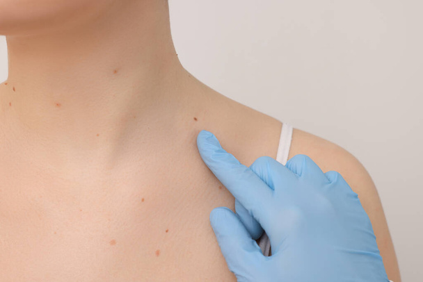 Dermatologist examining patient's birthmark on beige background, closeup - Фото, изображение