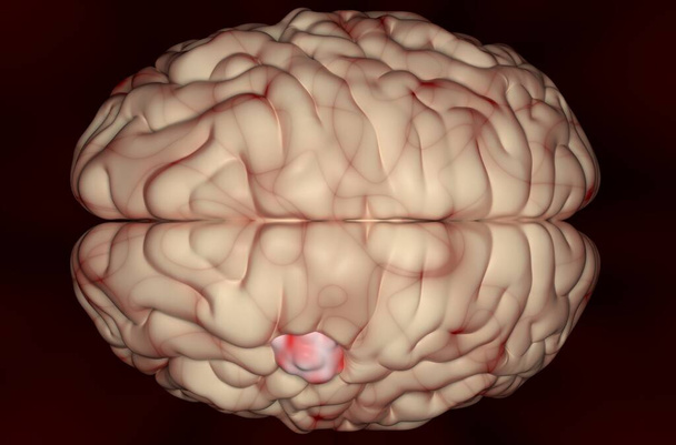 Meningioma (brain cancer) tumor in the brain tissue - 3d illustration top view - Photo, Image