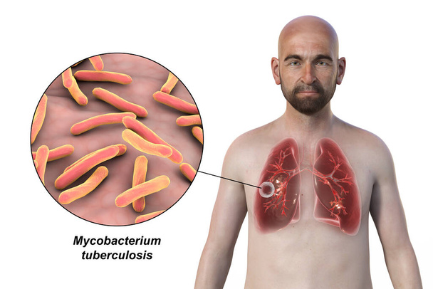 Een 3D fotorealistische illustratie van de bovenste helft van een man met een transparante huid, die de longen laat zien die aangetast zijn door holle tuberculose en een close-up van Mycobacterium tuberculosis bacteriën - Foto, afbeelding
