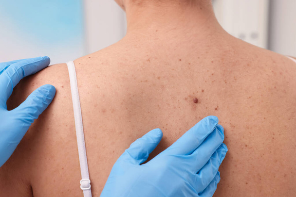 Dermatologist in rubber glove examining patient's birthmark, closeup view - Foto, afbeelding