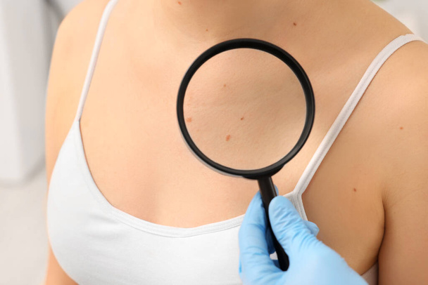 Dermatologist examining patient's birthmark with magnifying glass indoors, closeup - Foto, Imagem
