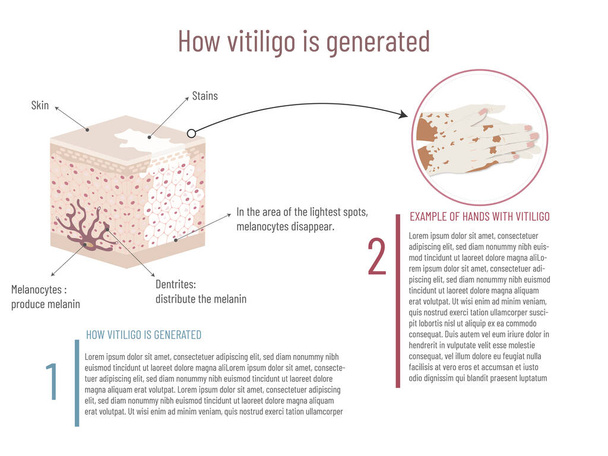 Infografica dell'origine della vitiligine e esempio visivo sulle mani, struttura della pelle e zona interessata su sfondo bianco. - Vettoriali, immagini